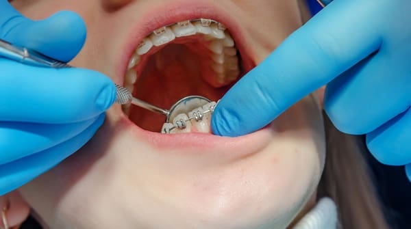 Webb Orthodontics - Braces care and emergencies